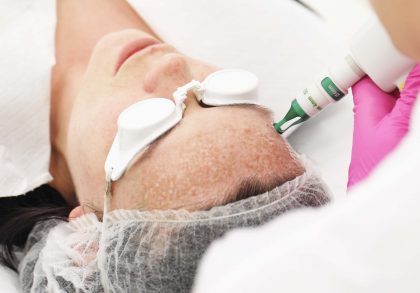 Redukcja_przebarwien_laserem_q_switch_alma_harmony_w_Klinice_Idealiste_Poznan